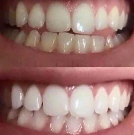 Snow Teeth Whitening Reviews (Before/After Photos)