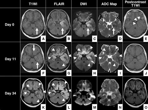 CT and MRI Findings of Human Herpesvirus 6–Associated Encephalopathy: Comparison With Findings ...