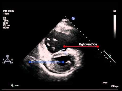 12A. Parasternal short axis view of right ventricular hypertrophy in ...