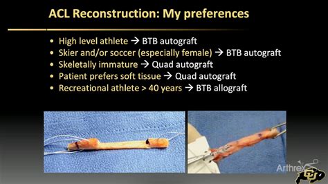 Arthrex - ACL Reconstruction: What Is My Graft of Choice?