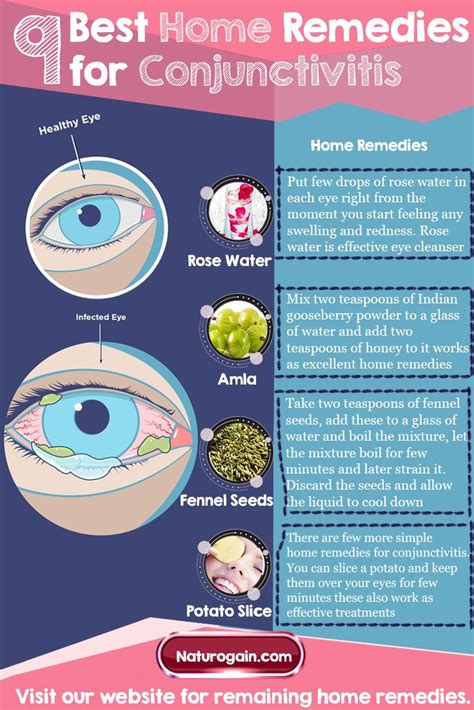 Home Remedies For Conjunctivitis | OnePronic