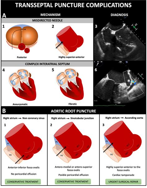 Transseptal puncture: Review of anatomy, techniques, complications and challenges, a critical ...