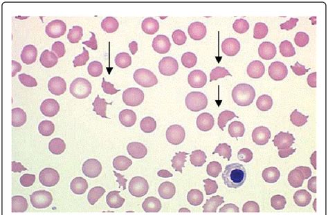 Hemolytic Anemia Blood Smear