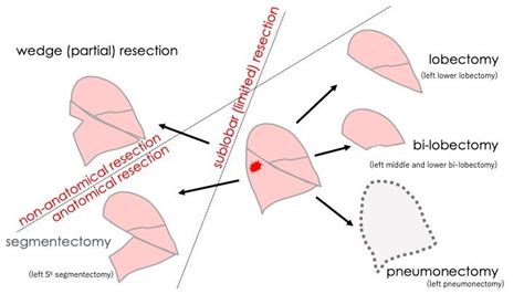 Sublobar Resections for Early Lung Cancer - ILCN.org (ILCN/WCLC)