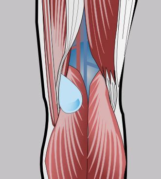 Popliteal cyst | KNEEguru