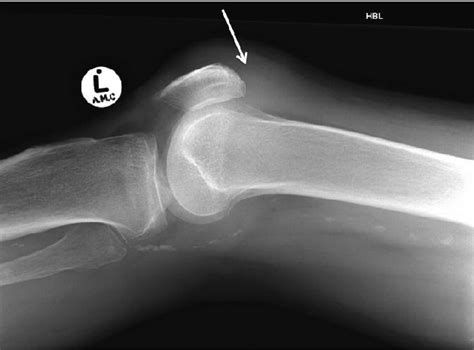 Quadriceps Tendon Tear Radiograph