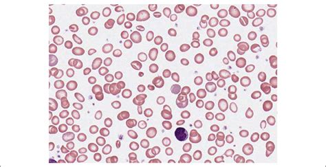 The peripheral blood smear shows anisocytosis and hypochromia with a... | Download Scientific ...