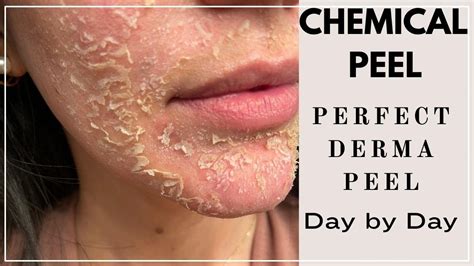 CHEMICAL PEEL | PERFECT DERMA PEEL - DAY BY DAY POST PROCEDURE | BY SARV - YouTube