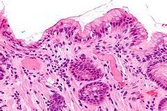 Gastric antral vascular ectasia - Libre Pathology