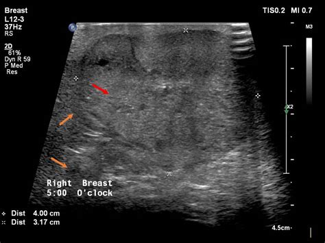 Atlas of breast cancer early detection