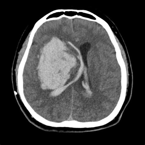 Lateral basal ganglia hemorrhage (BGH) in computed tomography (CT)... | Download Scientific Diagram