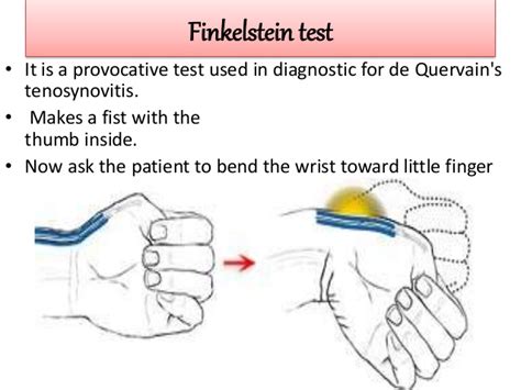 De Quervain's Tenosynovitis: Causes, Symptoms, Diagnosis & Treatment » How To Relief