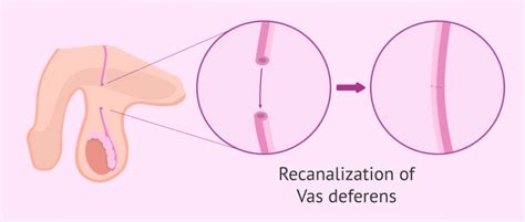 Vasosvasostomy: recanalization of the vas deferens