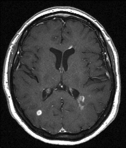 Mri Brain Scan Ms