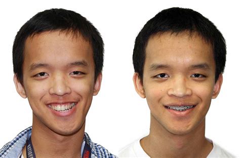 Facial Asymmetry Correction - Corrective Jaw Surgery - Dr. Antipov