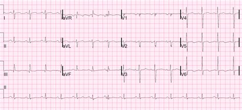 Dr. Smith's ECG Blog: Long QT: Do not trust the computerized QT interval when the QT is long