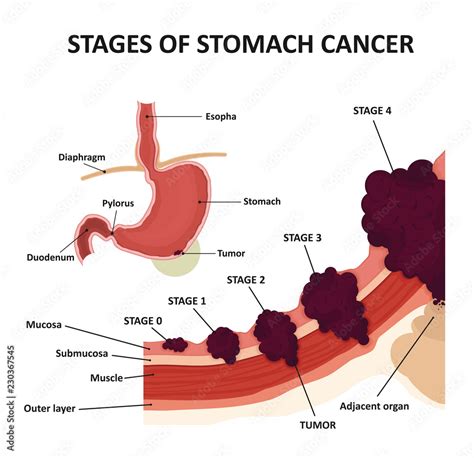 Stomach Cancer Stages