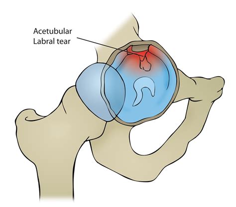 Acetabular Labrum