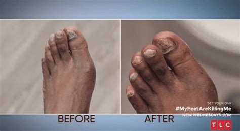 'My Feet Are Killing Me' Man Describes Feet As 'Horror Movie'