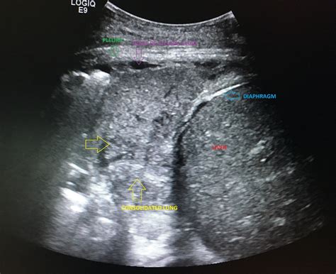 Lung Consolidation Vs Pleural Effusion