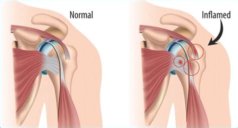 Shoulder Bursitis 2017 - Pro Health Care