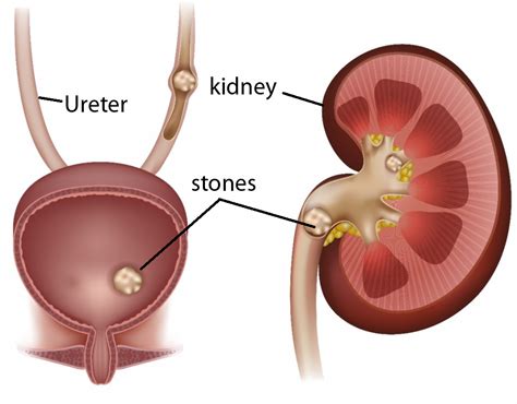 kidney stone: symptoms, risk factors, types, causes, - Health, Fitness, Nutrition and advice for ...