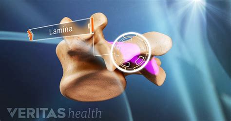 A Visual Guide to Lumbar Laminectomy Surgery