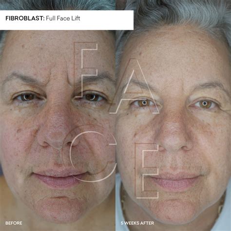 Plasma Fibroblast Before and After Results | Oakland & LA — FACE