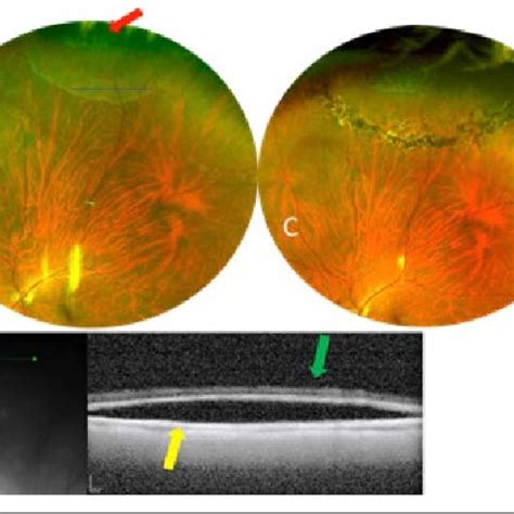 (A) Superior region of lattice degeneration with atrophic retinal holes... | Download Scientific ...