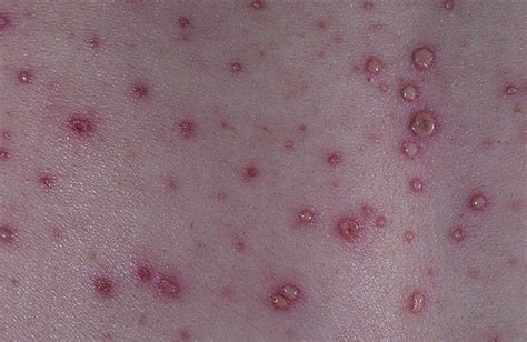 Chickenpox Picture (Hardin MD Super Site Sample)