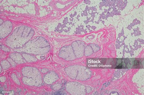 Mature Cystic Ovarian Teratoma Stock Photo - Download Image Now - Ovary, Cyst, Microscope Slide ...