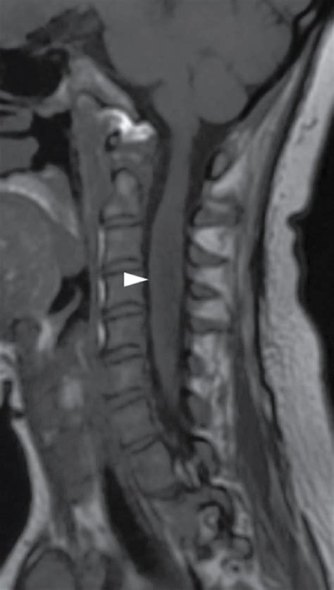 Cervical spinal cord MRI of an NMO patient in our center, a 32-year-old ...