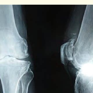 MRI left knee showing lipoma arborescens showing fat suppression on... | Download Scientific Diagram