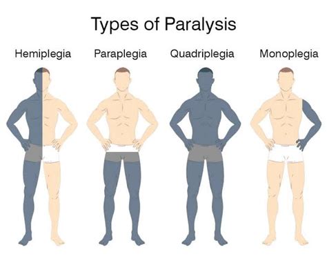 Paralysis - Symptoms, Causes & Treatment - Santripty