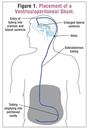 Review of the Treatment & Management of Hydrocephalus