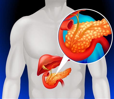 Pancreatic Cancer Risk Assessment: Uncover Your Personal Risk Factors