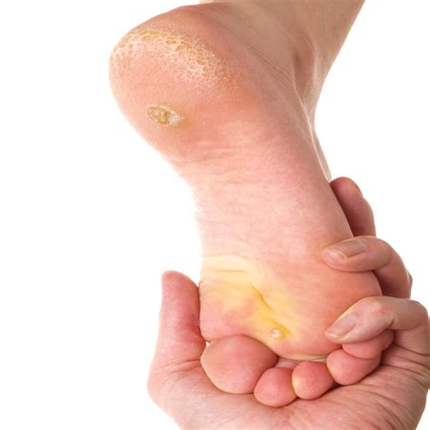 Corns and Calluses - Brampton Foot Clinic