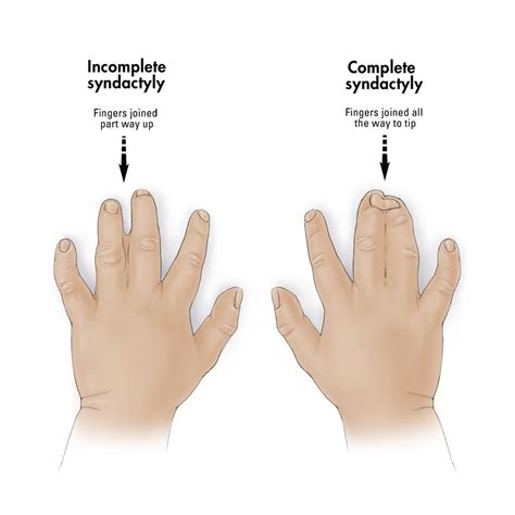 Syndactyly - Hand - Orthobullets