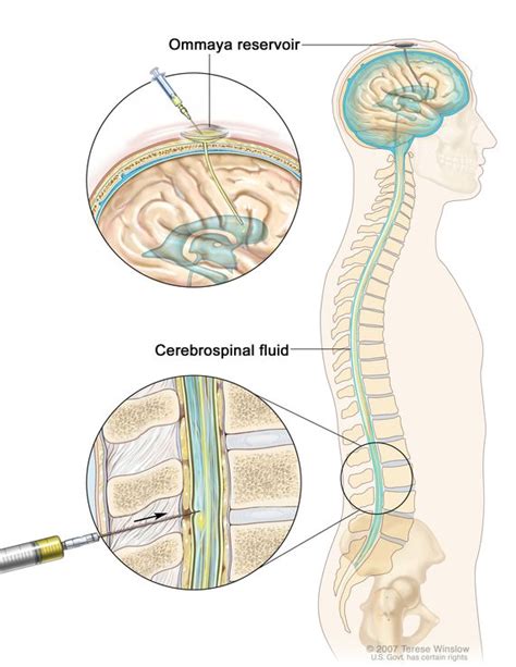 An Intrathecal Injection Is Directed Into - mapametawan