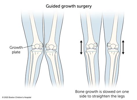 Knock Knees | Boston Children's Hospital