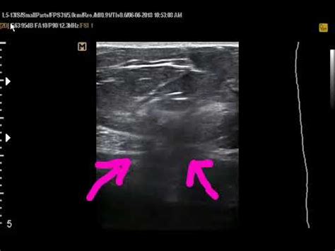 epigastric hernia ultrasound video - YouTube