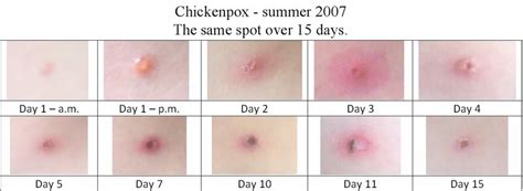 Symptoms and how the body is affected by this diseases - Chicken pox