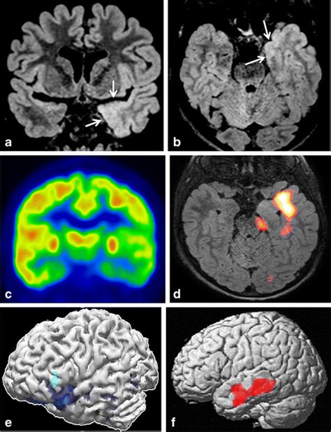 A 9-year-old girl with temporal lobe epilepsy with MRI findings ...