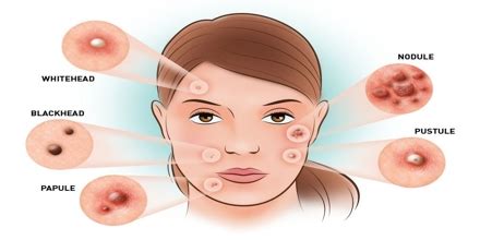 Acne: Skin Diseases - Assignment Point