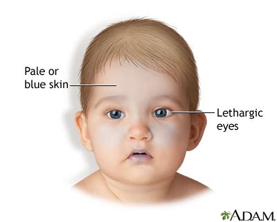 Shaken baby syndrome | UF Health, University of Florida Health