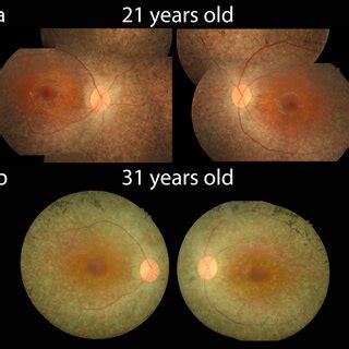 Color fundus of both eyes. a At presentation, fundus shows mild ...