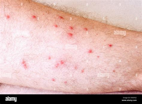 Rash allergy hi-res stock photography and images - Alamy