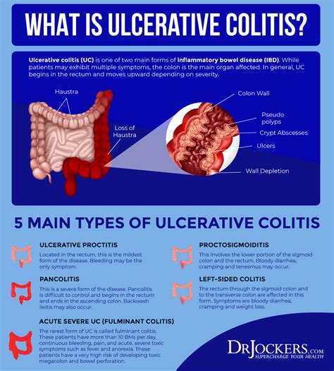 Ulcerative Colitis Stool