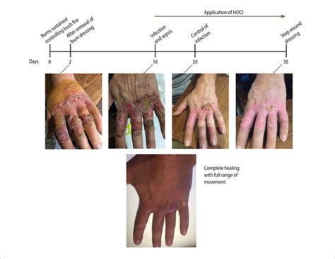 The use of hypochlorous acid in an infected burn wound – a case study ...