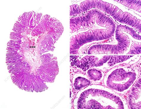 Polyp, Villous Adenoma, LM - Stock Image - C028/3347 - Science Photo Library